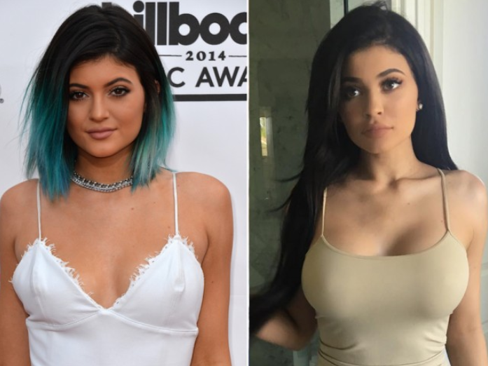 Kylie Jenners Rumoured Boob Job By Best Plastic Surgeon The Frisky