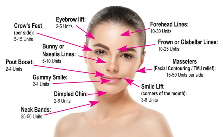 Top Facial Areas For Injecting Botox Cheek Lines Forehead Lines