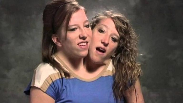The world became obsessed with conjoined twins abigail abby and brittany he...
