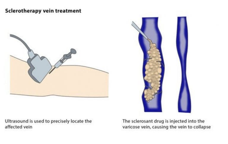 Informative Guide To Varicose Veins Treatment Options The Frisky 3257