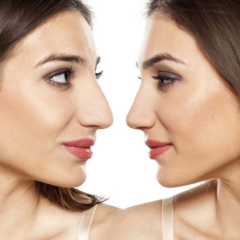 5 Limitations Of Rhinoplasty Explained The Frisky