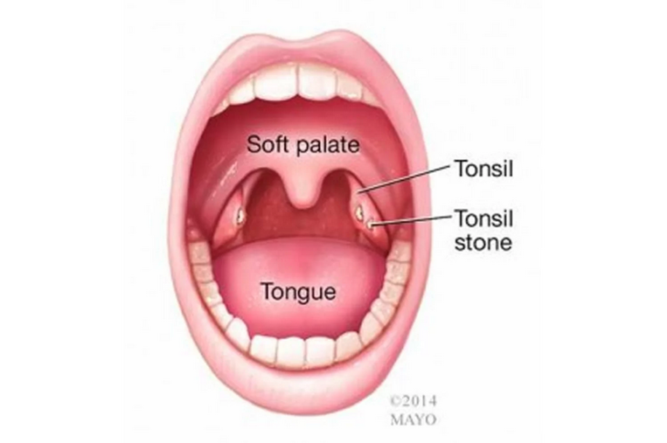 Gross Talk: Do You Pop Your Tonsil Stones? - The Frisky