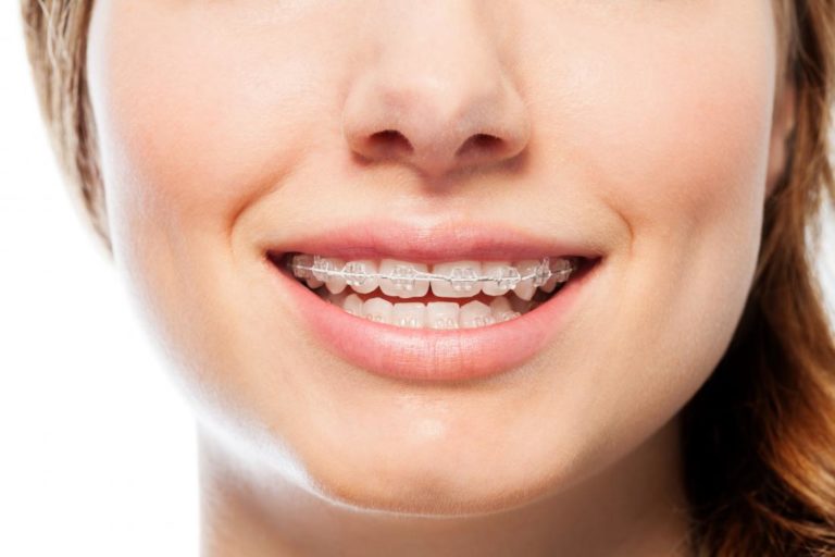Everything you need to know about wearing braces The Frisky