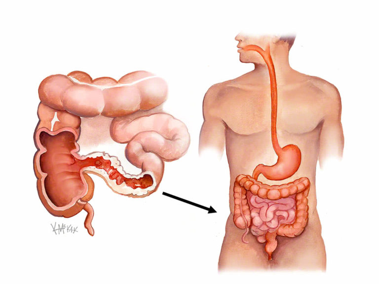 Crohn’s Disease causes, symptoms, and treatments The Frisky