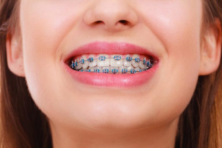 How Much Does It Cost To Get Braces The Frisky 