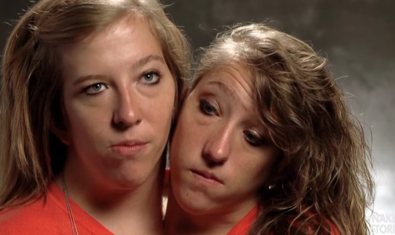 These Conjoined Twins Are Amazing Us Once Again 