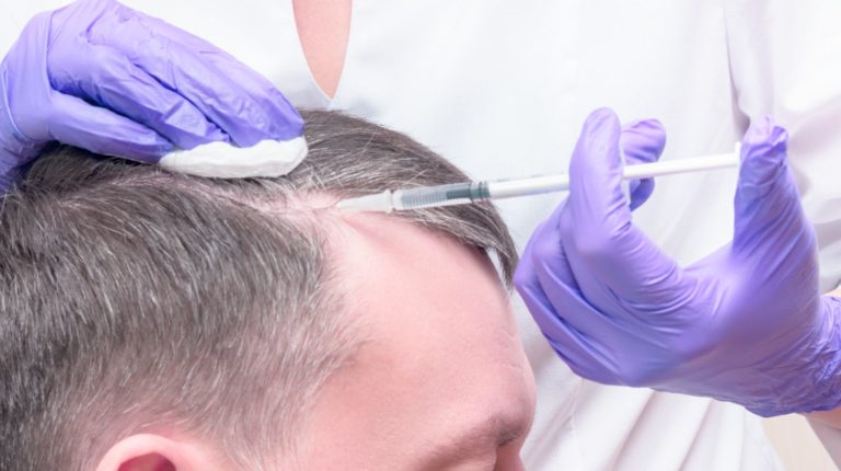 8 Facts about PRP for Hair Loss - The Frisky