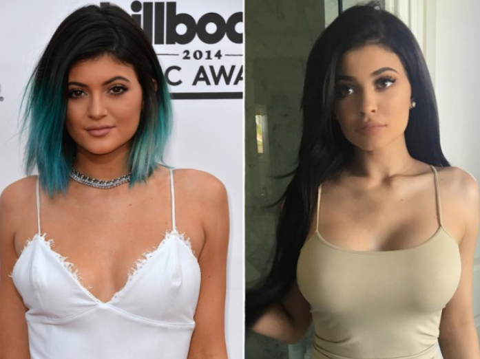 Kylie Jenners Rumoured Boob Job By Best Plastic Surgeon The Frisky 