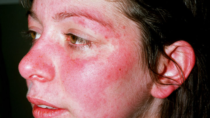 13-early-warning-signs-of-lupus-you-need-to-know-and-what-to-do-the