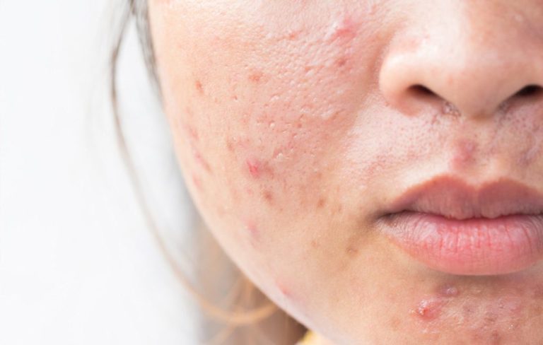 Photo 💓 Acne treatment for hormonal imbalances in women | Demystifying Hormonal Acne 💓