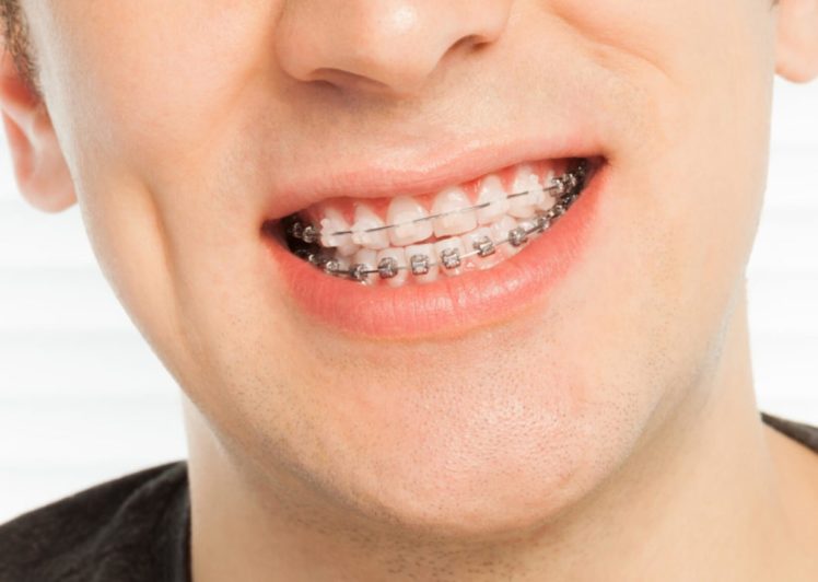 5 Most Common Types of Braces for Your Child 2020 Guide