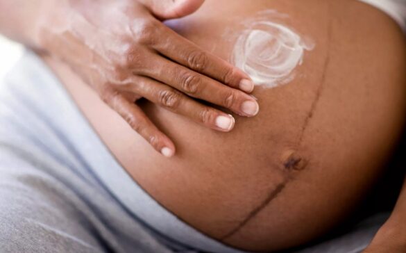 Teen Stretch Marks And How To Get Rid Of Them Skinomatics Skincare