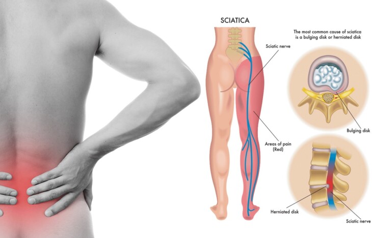 How To Cure Sciatica Permanently The Frisky