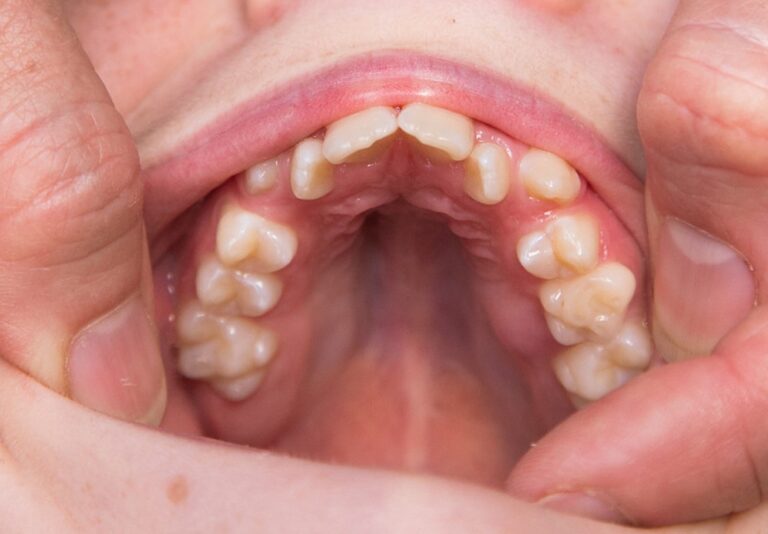 Impact Of Thumb Sucking On Teeth And How To Prevent It The Frisky