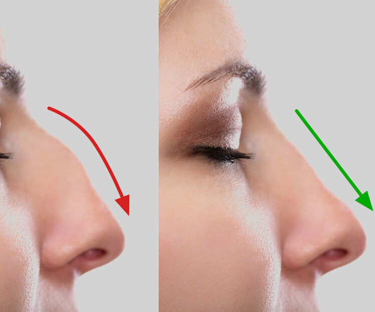 How Long Does It Take To Recover From Rhinoplasty Surgery The Frisky