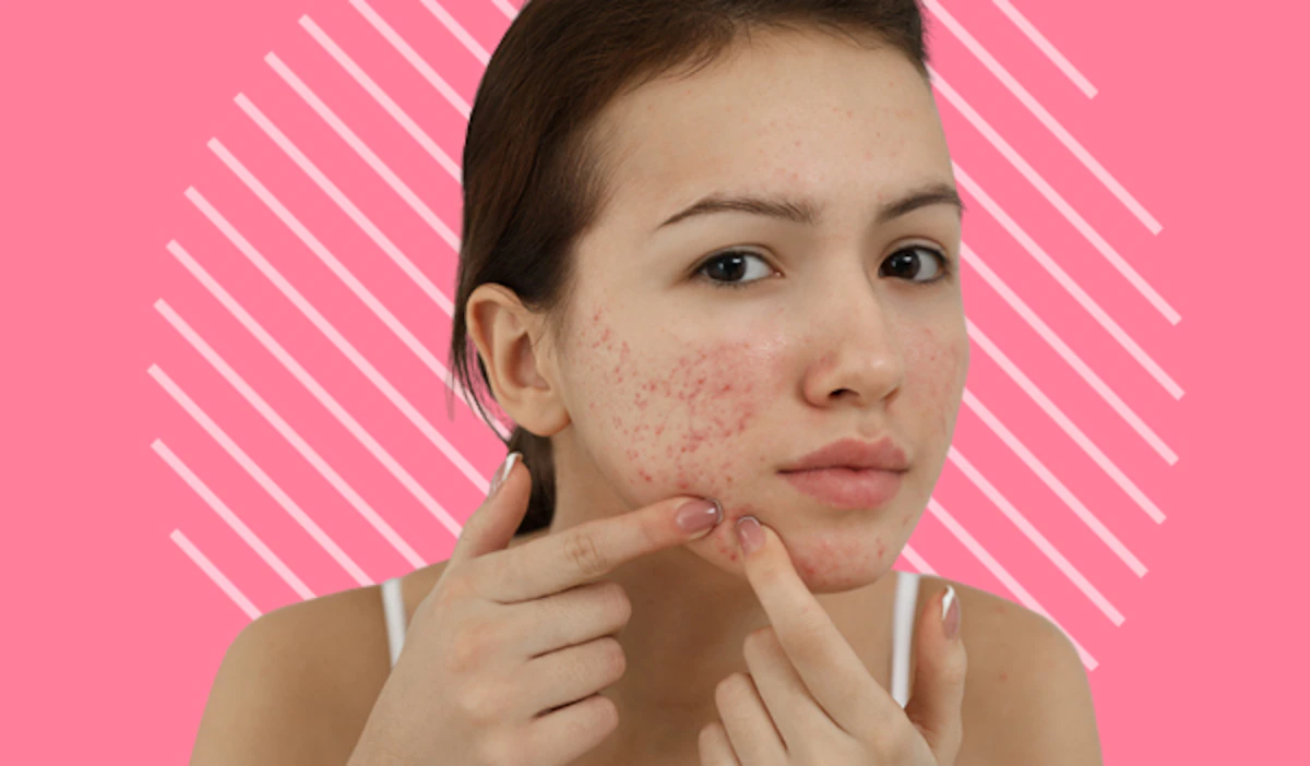 an-at-home-remedy-for-acne-the-frisky