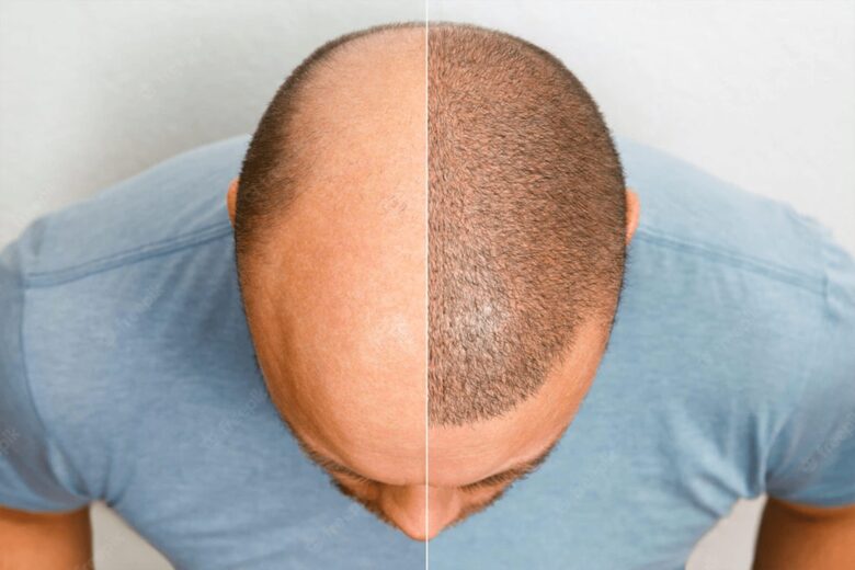 Why to choose USA for hair transplant