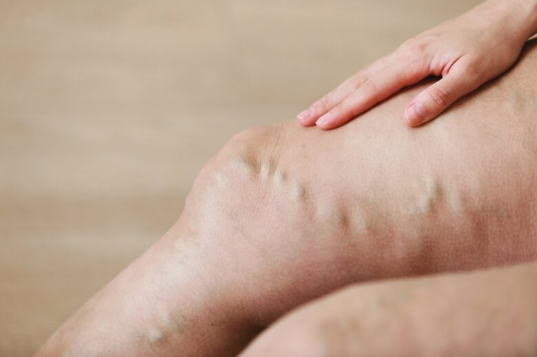 Close-up of a leg with visible veins and hand resting on the knee, representing nighttime leg discomfort and restlessness