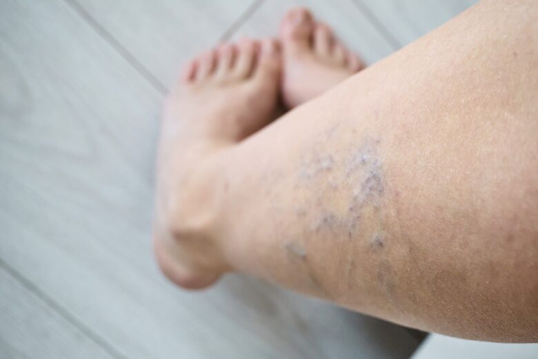 Venous Insufficiency