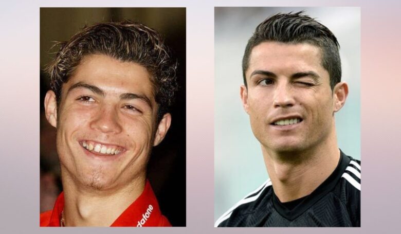 Side by side comparison showing a young athlete with an uneven smile and a later photo with straighter, more polished teeth