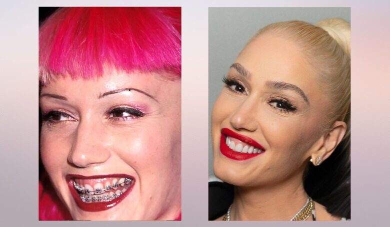 Side by side comparison showing a woman with braces and colorful hair in an earlier photo and a later image with a bright, polished smile