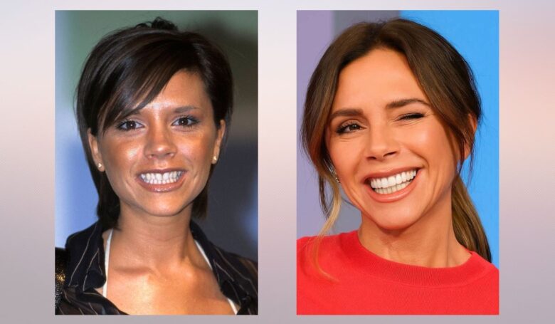 Side by side comparison showing a woman with an earlier smile and a later image featuring a brighter, more symmetrical smile