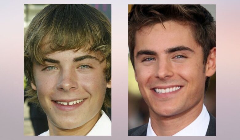 Side by side comparison of a young actor smiling as a teenager and later with a more polished, brighter smile